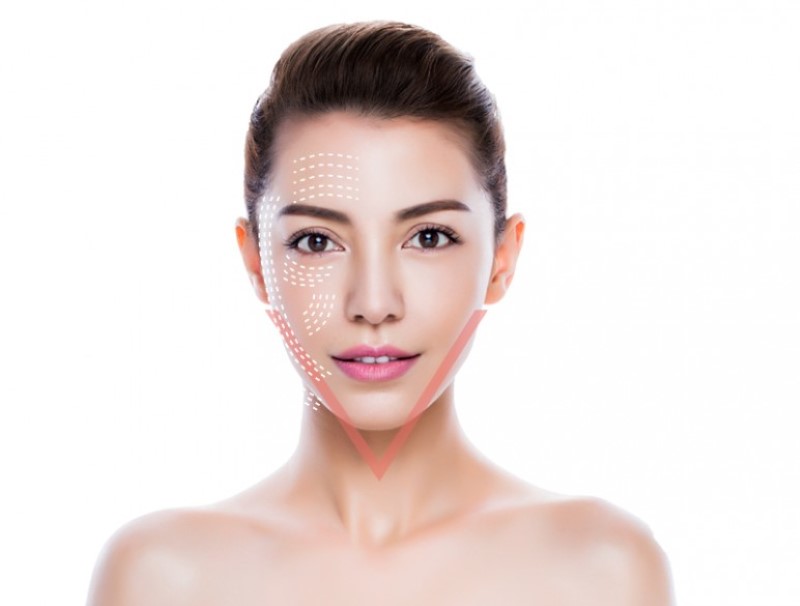 Căng chỉ collagen có đảm bảo 