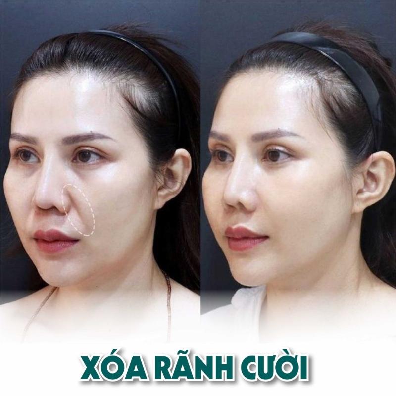 Có nên tiêm botox rãnh cười không?