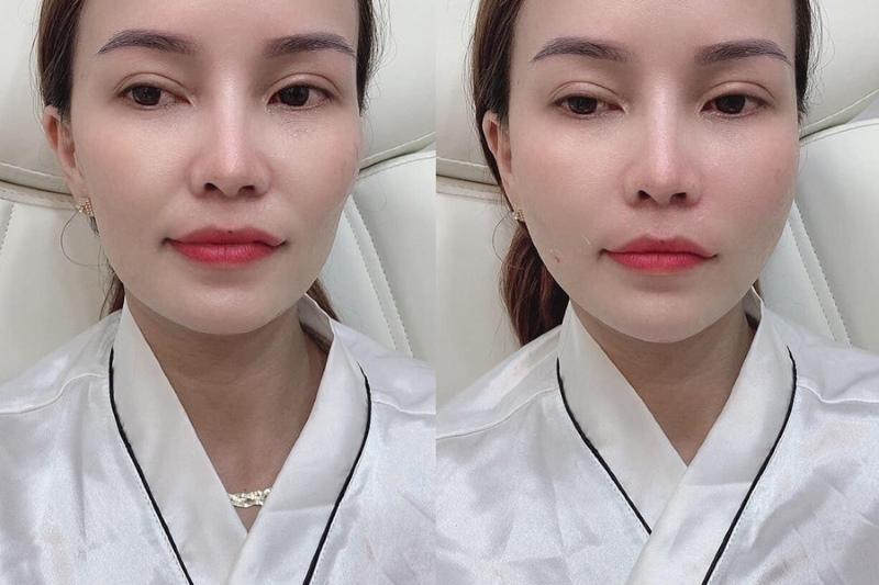 Miệng có bị đơ… nếu tiêm botox xóa rãnh cười hay không? 