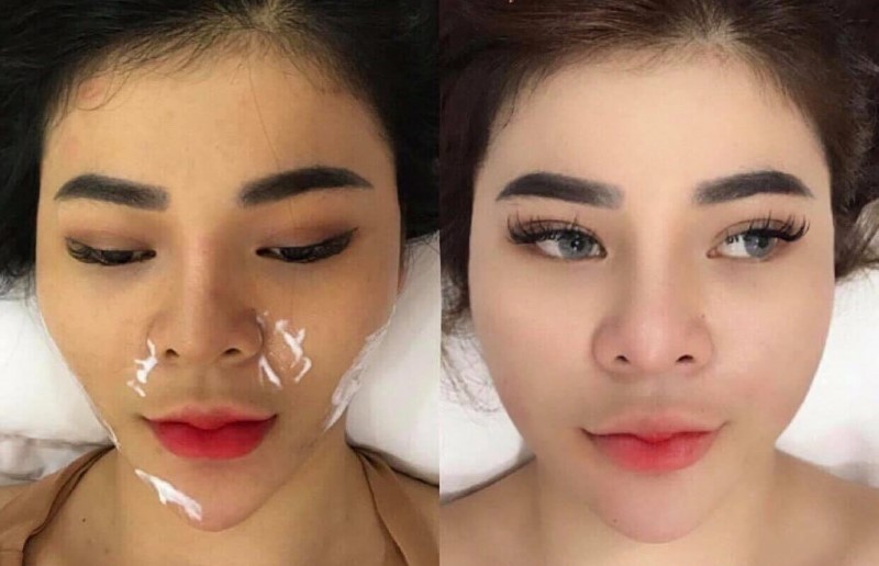 Thế nào là một cơ sở tiêm filler cằm tròn uy tín?