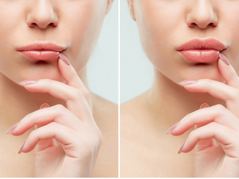 Các ưu điểm đặc biệt của phương pháp tiêm filler môi