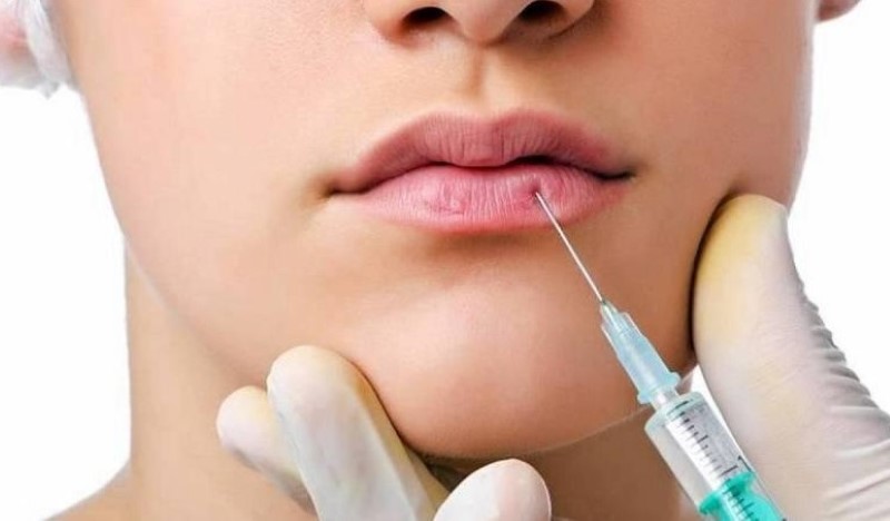 Phương pháp tiêm filler môi được hiểu như thế nào? 