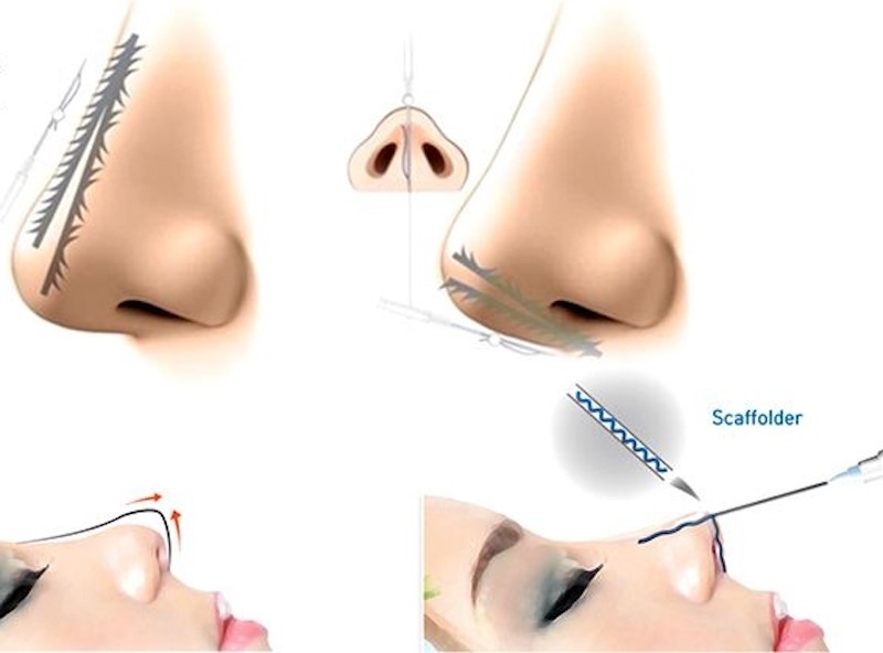 Phương pháp nâng mũi không phẫu thuật 