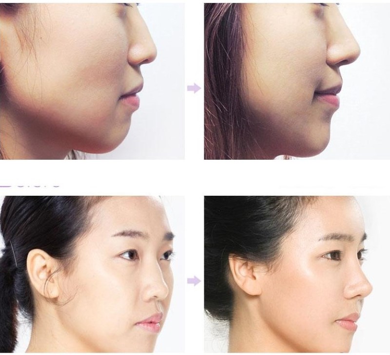 Đối tượng nào nên tiêm filler mũi?