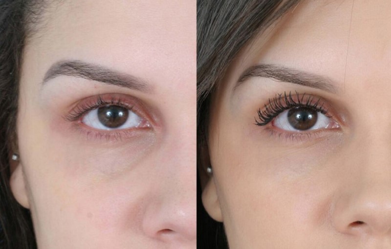 Hiệu quả của phương pháp tiêm filler quầng thâm mắt có lâu bền hay không? 