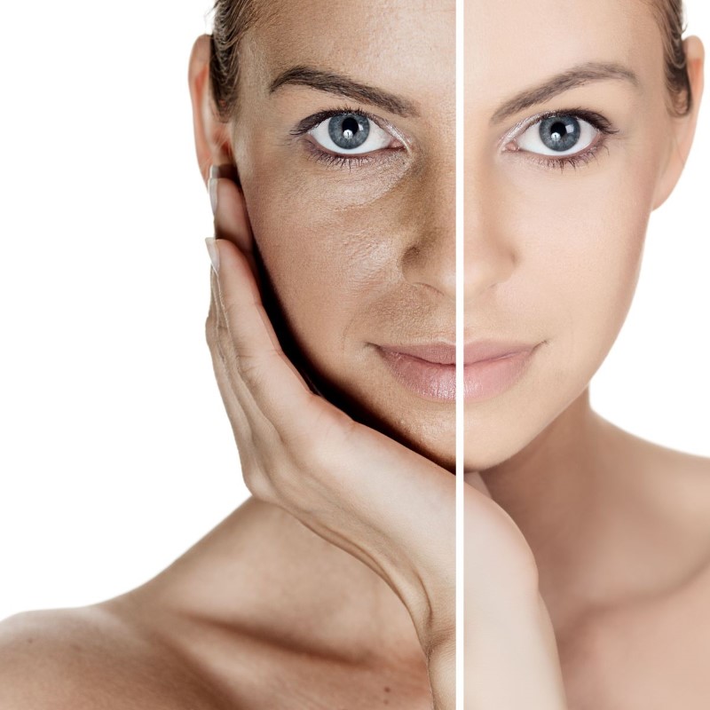 Những ai thích hợp sử dụng phương pháp căng da mặt? 