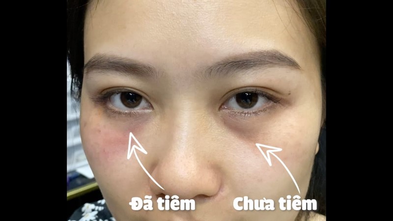 Phương pháp tiêm filler bọng mắt dưới có các ưu điểm nào? 