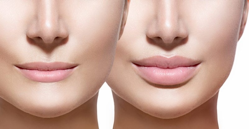 Hiệu quả của tiêm filler môi là bao lâu?