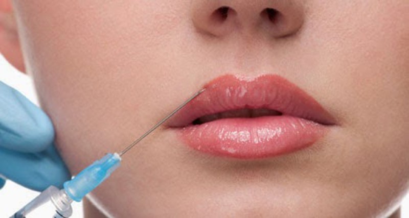 Thế nào là phương pháp tiêm filler môi?