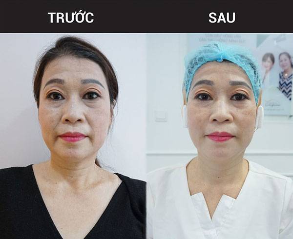 Công Nghệ HIFU Giải Pháp Đột Phá Trong Làm Đẹp