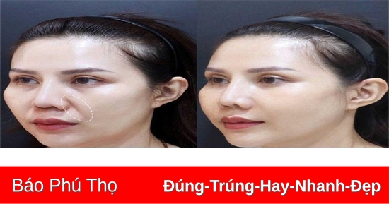 Bài Tập Xoá Rãnh Cười Giảm Thiểu Nếp Nhăn Vùng Mắt Hiệu Quả